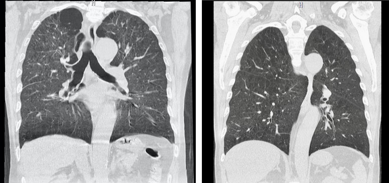 閉塞性肺疾患(COPD)